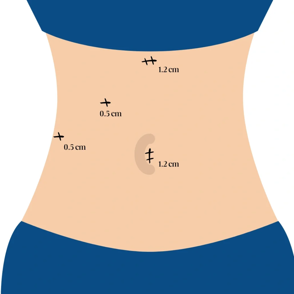 cirugia-laparoscopica-1-1024x1024